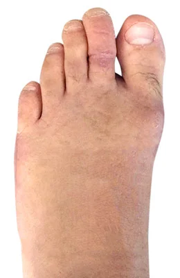 Lapidus Forever Bunionectomy™ and Hammertoe Correction after