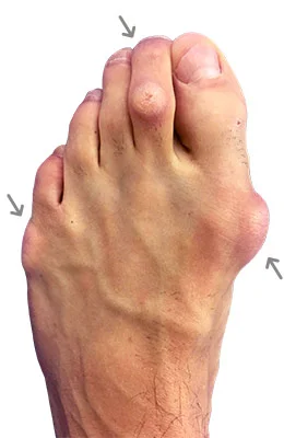 Lapidus Forever Bunionectomy™ and Hammertoe Correction before
