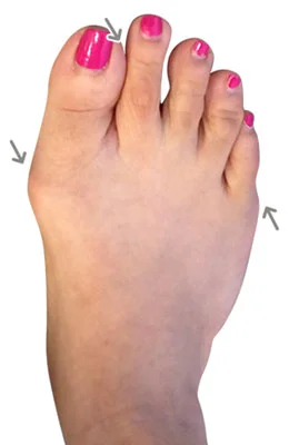 Lapidus Forever Bunionectomy™, Hammertoe Correction, Tailor's Bunionectomy before