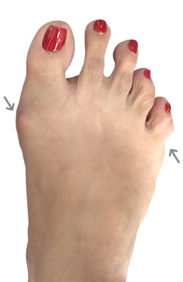 Bunionectomy and Tailor's Bunion Correction before