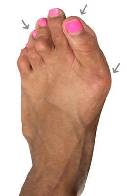 Failed Bunion Revision Surgery before