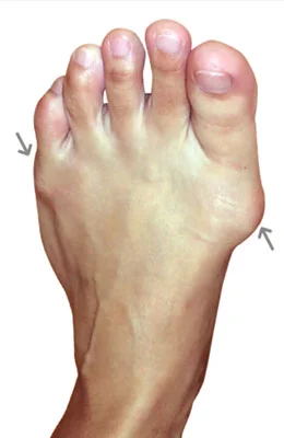 Lapidus Forever Bunionectomy™ and a Osteotomy Tailor’s Bunionectomy before