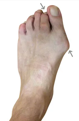 Lapidus Forever Bunionectomy™ with Hammertoe Correction and Planter Plate Repair before