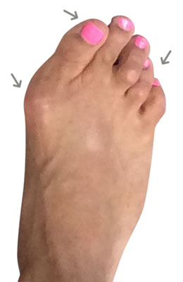Lapidus Forever Bunionectomy™ with Hammertoe Correction before