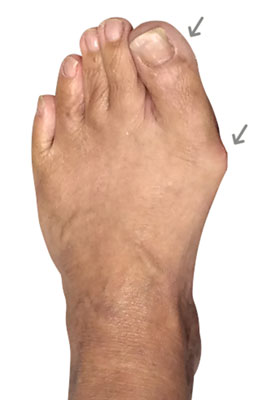 Osteotomy Bunionectomy before