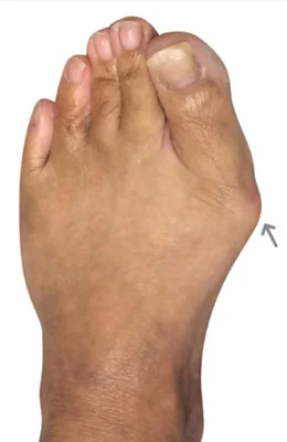 MinVasive™ Minimally Invasive Bunionectomy featuring the CrossRoads miniBunion™ System before