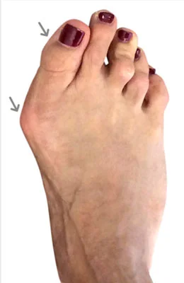 Forever Lapidus Bunionectomy™ and Hammertoe Correction before