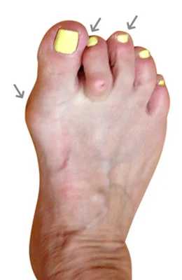 miniBunion™ Osteotomy Bunionectomy with Hammertoe Correction and Plantar Plate Repair before