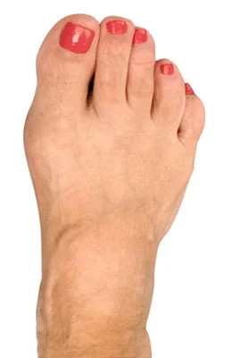 Bunionectomy featuring the CrossRoads miniBunion™ System after