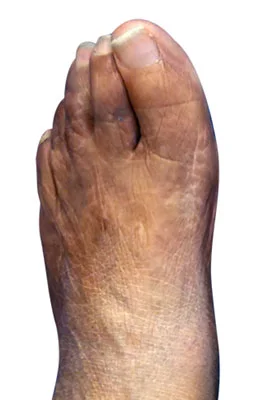 Lapidus Forever Bunionectomy™ and Hammertoe Correction with Tailor's Bunionectomy after