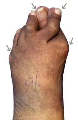 Lapidus Forever Bunionectomy™ and Hammertoe Correction with Tailor's Bunionectomy before