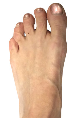 miniBunon™ Minimally Invasive Bunionectomy after