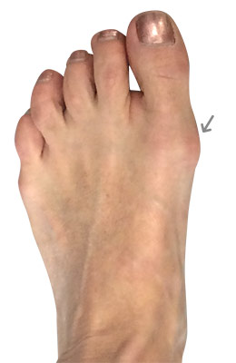 miniBunon™ Minimally Invasive Bunionectomy before