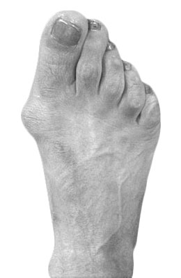 Osteotomy Bunionectomy before