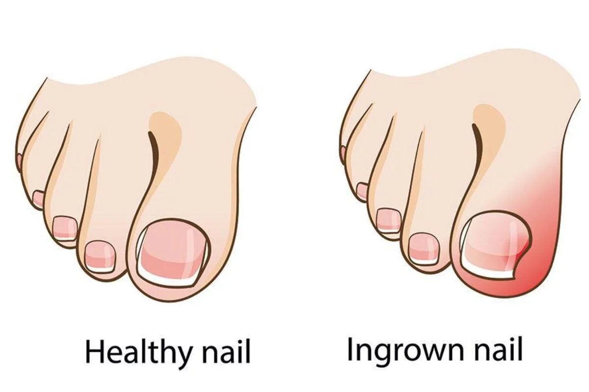 How to cut an ingrown toenail: Home and medical procedures