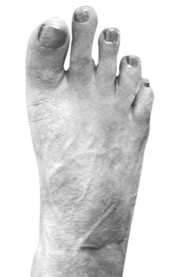 Osteotomy Bunionectomy after