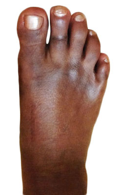 Lapidus Forever Bunionectomy™, Hammertoe Correction, Osteotomy Tailors Bunion Surgery after