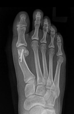 Osteotomy Bunionectomy after