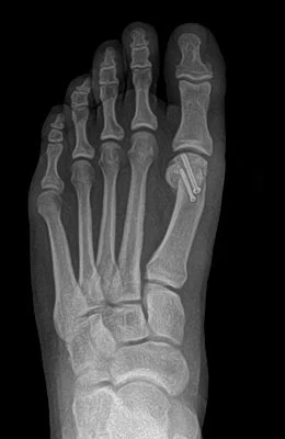 Osteotomy Bunionectomy after