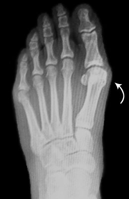 Osteotomy Bunionectomy before