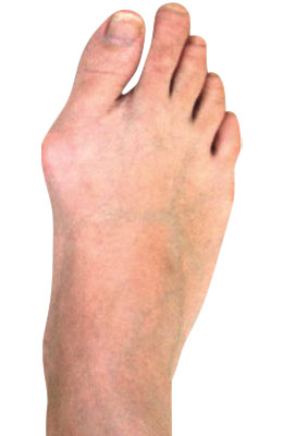 Osteotomy Bunion Surgery before