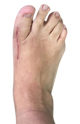 Revision Hallux Varus Correction after