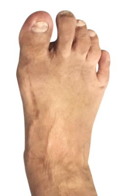 Lapidus Forever Bunionectomy™ after