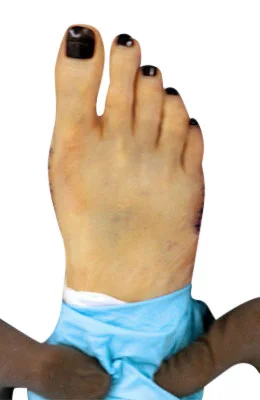 Osteotomy Bunionectomy and Tailor's Bunionectomy after