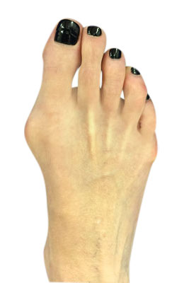 Osteotomy Bunionectomy and Osteotomy Tailors Bunionectomy BEFORE