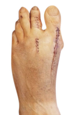 Revision of Failed Previous Bunion Surgery after