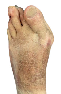 Revision of Failed Previous Bunion Surgery before