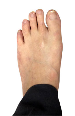 Osteotomy Bunion Surgery after