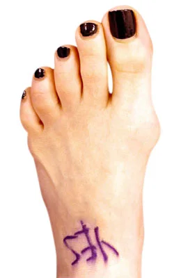 Minimally Invasive Bunion Surgery before