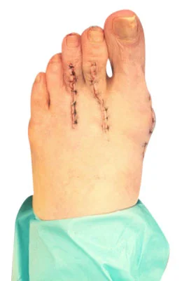 Osteotomy Bunionectomy, Hammertoe Correction and Plantar Plate Repair after