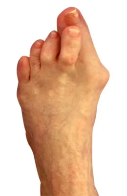 Osteotomy Bunionectomy, Hammertoe Correction and Plantar Plate Repair before