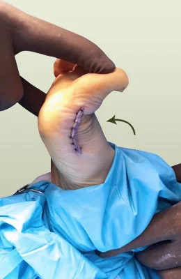 Hallux Limitus Surgery after
