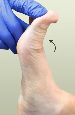 Hallux Limitus Surgery before