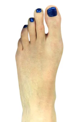 Bunion Correction through Osteotomy Bunionectomy after