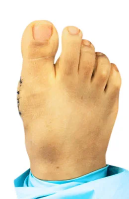 Osteotomy Bunionectomy after