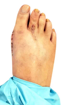 Osteotomy Bunionectomy and Plantar Plate Repair after
