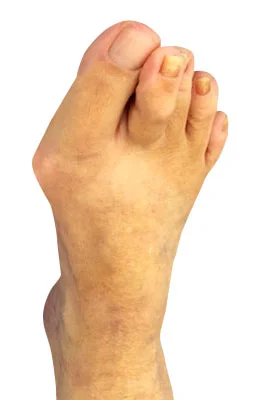 Osteotomy Bunionectomy and Plantar Plate Repair before