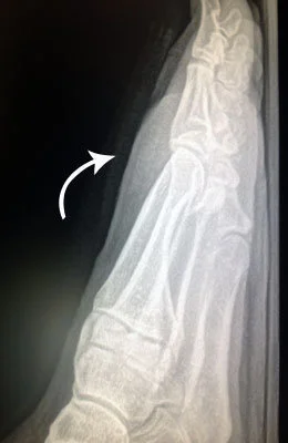 Bone Spur Removal after