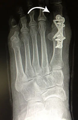 Great Toe Fusion after