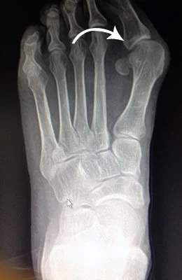 Great Toe Fusion before