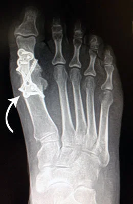 Hallus Limitus Fusion Surgery after