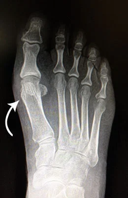 Hallus Limitus Fusion Surgery before