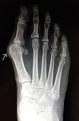 Lapidus Forever Bunionectomy™, Hammertoe Correction, Osteotomy Tailors Bunion Surgery before