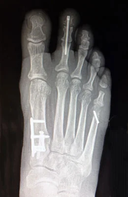 Lapidus Bunionectomy, Hammertoe Correction, Osteotomy Tailors Bunion Surgery after