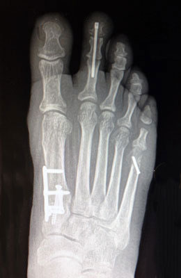 Lapidus Forever Bunionectomy™, Hammertoe Correction, Osteotomy Tailors Bunion Surgery after