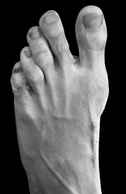 Lapidus Forever Bunionectomy™, Hammertoe Correction 5th Intermediate after